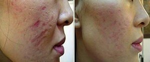 1309216299_219322221_4-Dermaroller-Rejuvenecimiento-Facial-Estrias-Cicatrices-Compra-Venta