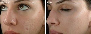 Acne improvement after dermarolling therapy, before and after pictures
