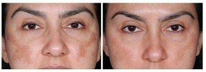 Before and after picture Hyperpigmentation Dermaroller Treatment