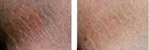 Stretch marks treatment with dermaroller, before and after photos