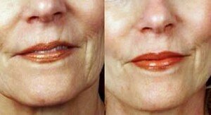 Antiaging-Wrinkle rejuvenation with derma roller, before and after images