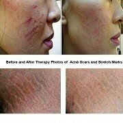 derma-roller-before-and-after