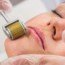 A Brief History of the Derma Roller